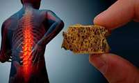 Osteoporosis, a Silent Epidemic Threatening the Elderly Population